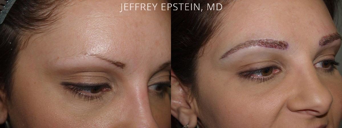 Eyebrow Before and after in Miami, FL, Paciente 36397