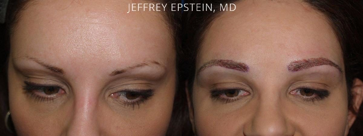 Eyebrow Hair Transplant Before and after in Miami, FL, Paciente 36397
