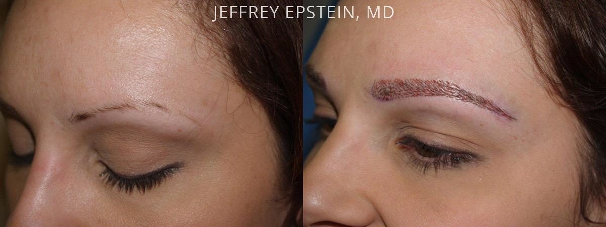 Eyebrow Hair Transplant Before and after in Miami, FL, Paciente 36397
