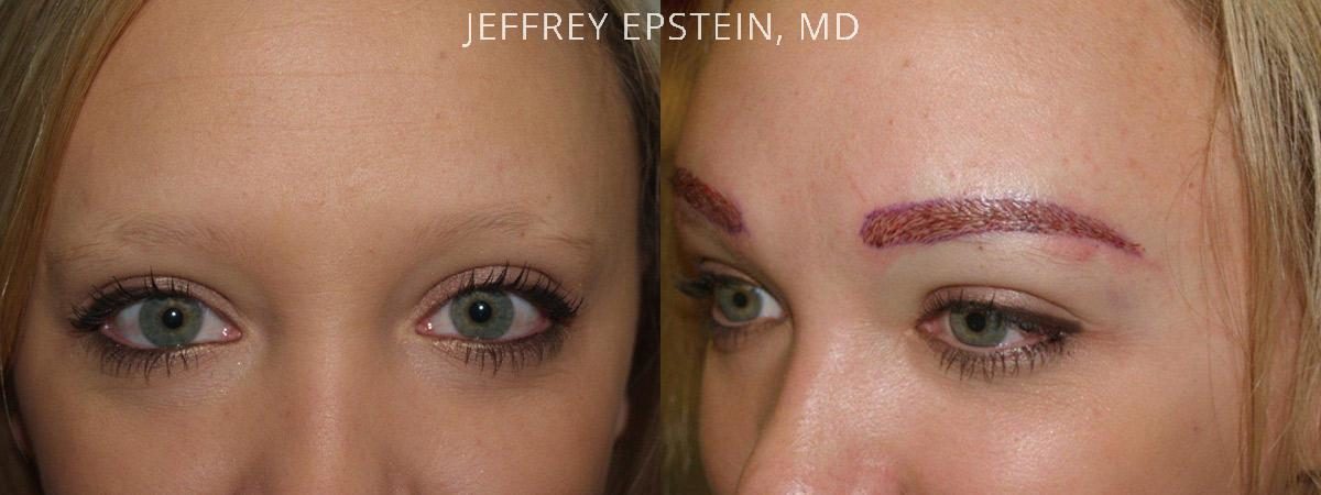 Eyebrow Before and after in Miami, FL, Paciente 36409