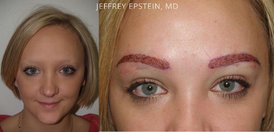 Eyebrow Before and after in Miami, FL, Paciente 36409