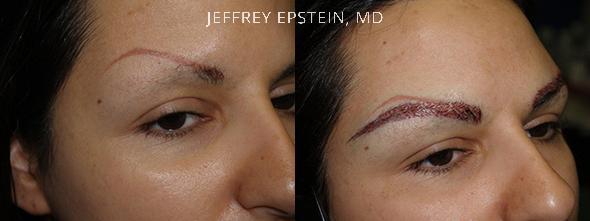 Eyebrow Before and after in Miami, FL, Paciente 36419