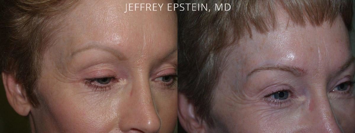 Eyebrow Before and after in Miami, FL, Paciente 36429
