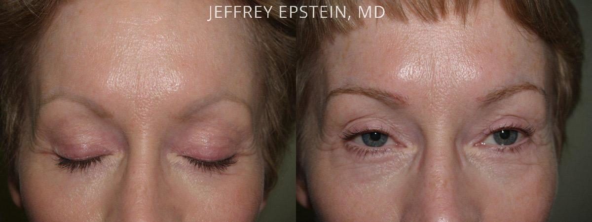 Eyebrow Before and after in Miami, FL, Paciente 36429