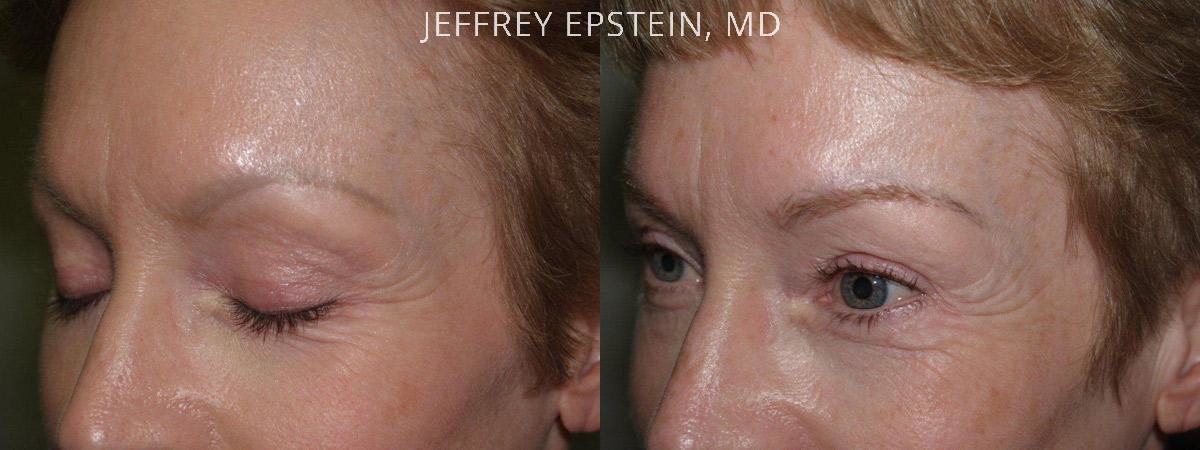 Eyebrow Hair Transplant Before and after in Miami, FL, Paciente 36429