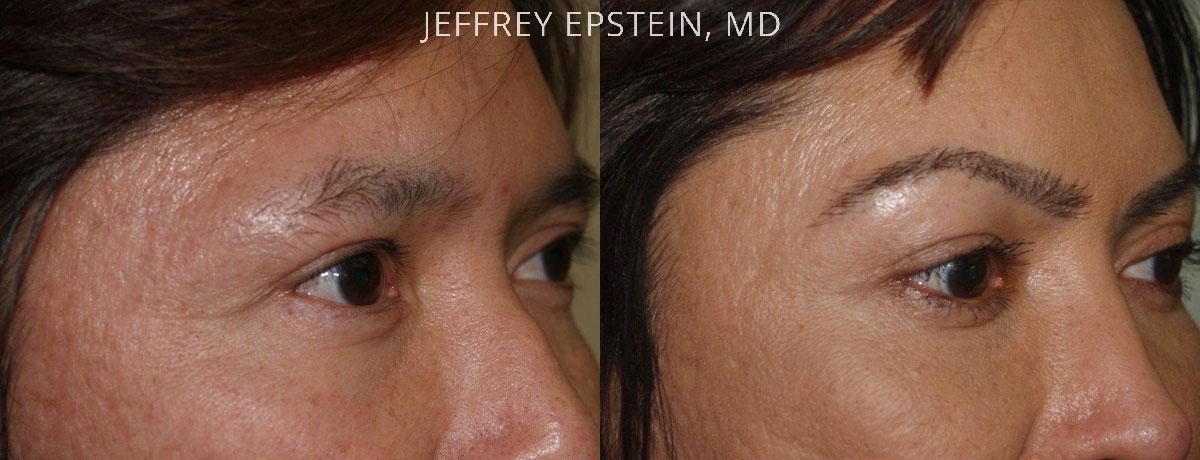 Eyebrow Hair Transplant Before and after in Miami, FL, Paciente 36445