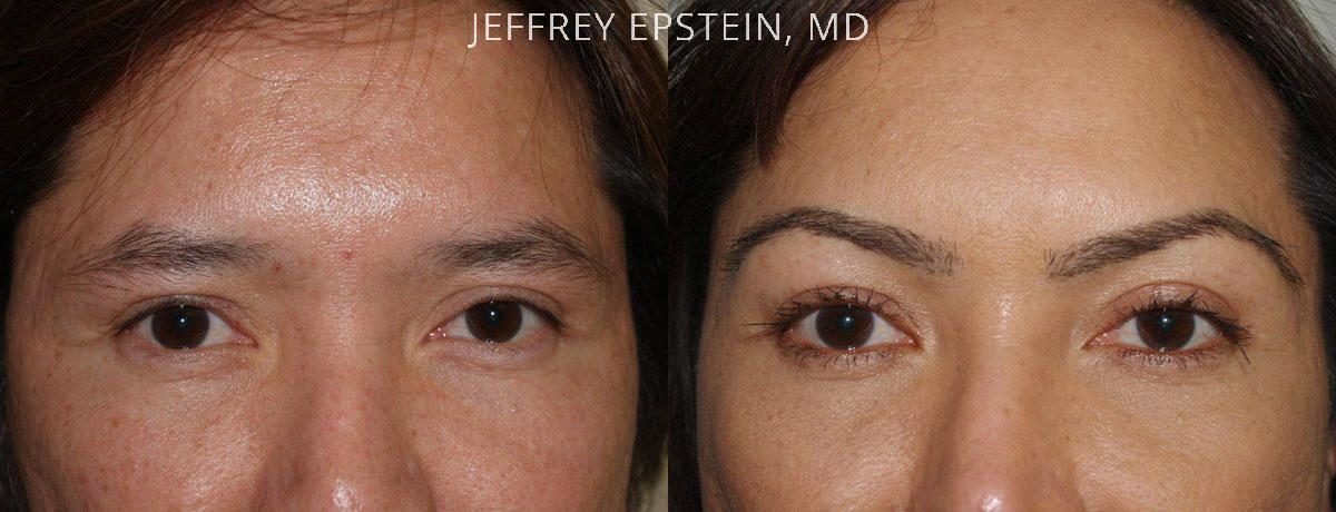 Eyebrow Before and after in Miami, FL, Paciente 36445