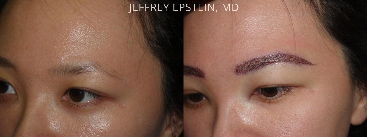 Eyebrow Hair Transplant Before and after in Miami, FL, Paciente 36455