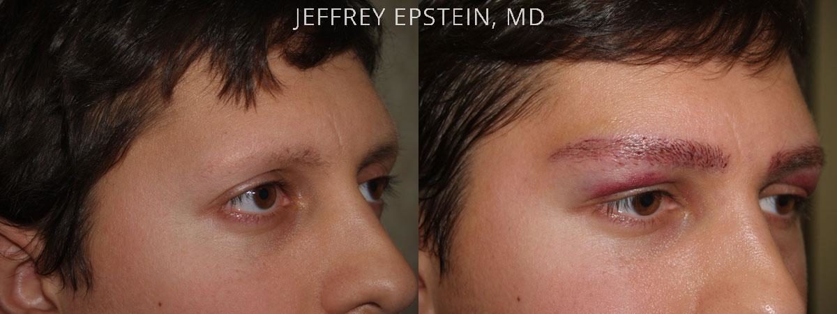 Eyebrow Hair Transplant Before and after in Miami, FL, Paciente 36467