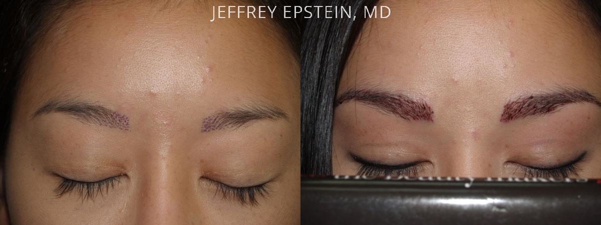 Eyebrow Hair Transplant Before and after in Miami, FL, Paciente 36472