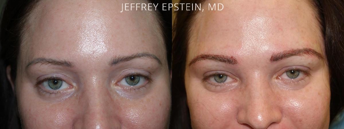 Eyebrow Hair Transplant Before and after in Miami, FL, Paciente 36477