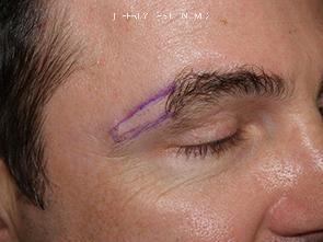 Eyebrow Before and after in Miami, FL, Paciente 36489