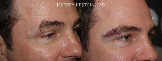 Eyebrow Hair Transplant Before and after in Miami, FL, Paciente 36489