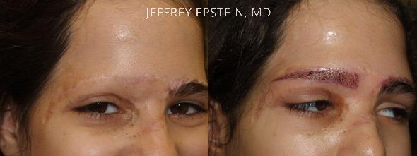 Eyebrow Hair Transplant Before and after in Miami, FL, Paciente 36493