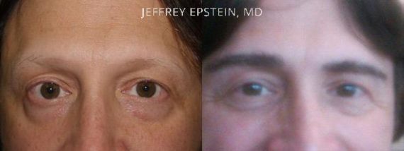 Eyebrow Hair Transplant Before and after in Miami, FL, Paciente 36508