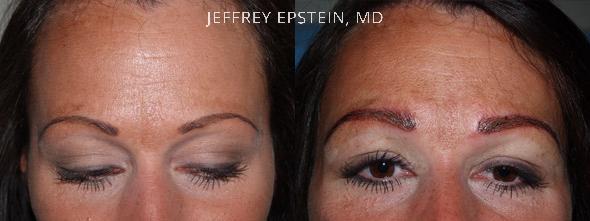 Eyebrow Hair Transplant Before and after in Miami, FL, Paciente 36511