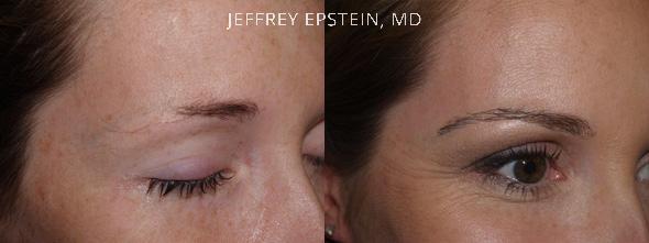 Eyebrow Hair Transplant Before and after in Miami, FL, Paciente 36515