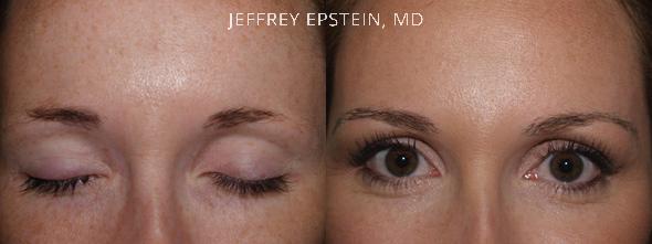 Eyebrow Hair Transplant Before and after in Miami, FL, Paciente 36515