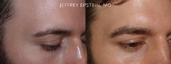 Eyebrow Before and after in Miami, FL, Paciente 36520