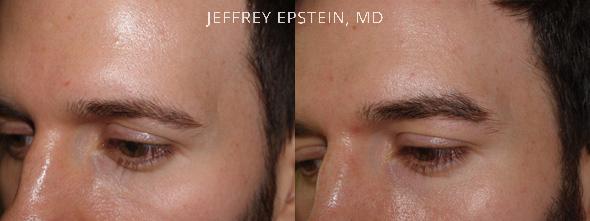 Eyebrow Hair Transplant Before and after in Miami, FL, Paciente 36520