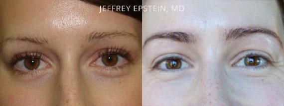 Eyebrow Before and after in Miami, FL, Paciente 36527