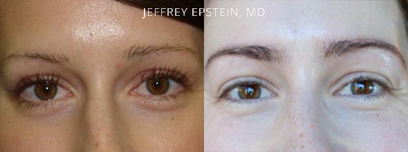 Eyebrow Hair Transplant Before and after in Miami, FL, Paciente 36527