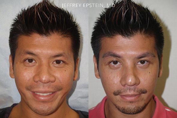 Eyebrow Hair Transplant Before and after in Miami, FL, Paciente 36543