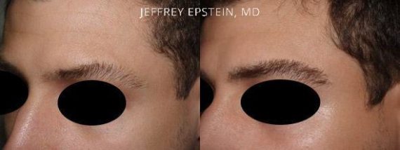 Eyebrow Hair Transplant Before and after in Miami, FL, Paciente 36553