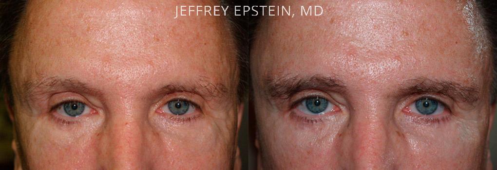 Eyebrow Hair Transplant Before and after in Miami, FL, Paciente 36594