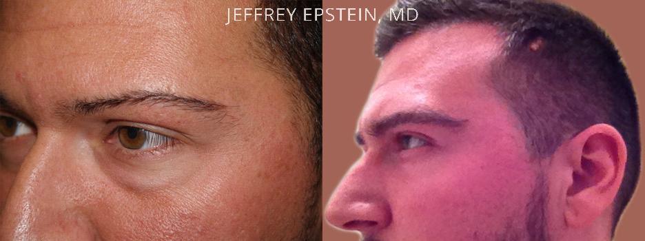 Eyebrow Hair Transplant Before and after in Miami, FL, Paciente 36607