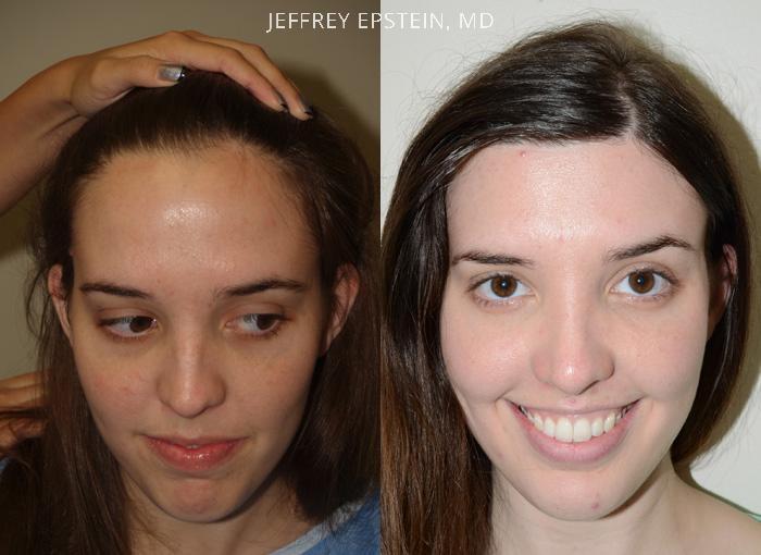 Forehead Reduction Surgery Before and after in Miami, FL, Paciente 36634
