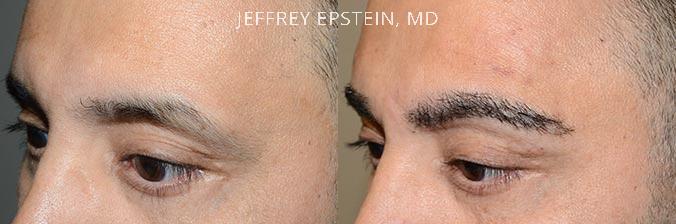 Eyebrow Hair Transplant Before and after in Miami, FL, Paciente 36663