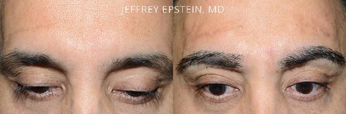 Eyebrow Hair Transplant Before and after in Miami, FL, Paciente 36663