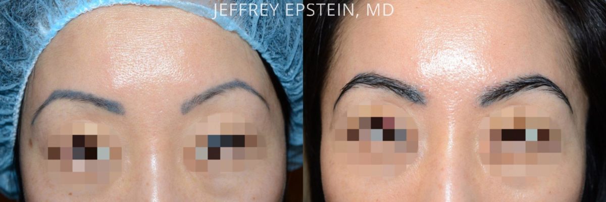 Eyebrow Hair Transplant Before and after in Miami, FL, Paciente 36677