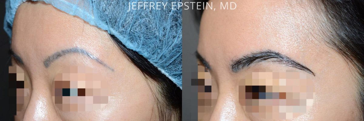 Eyebrow Before and after in Miami, FL, Paciente 36677