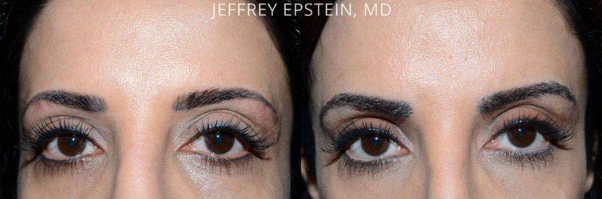 Eyebrow Hair Transplant Before and after in Miami, FL, Paciente 36684