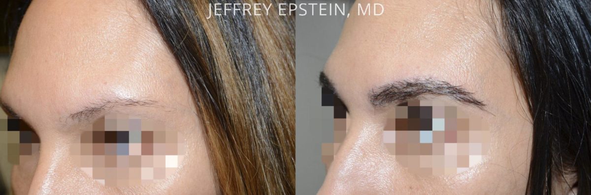 Eyebrow Hair Transplant Before and after in Miami, FL, Paciente 36706