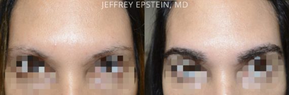 Eyebrow Hair Transplant Before and after in Miami, FL, Paciente 36706