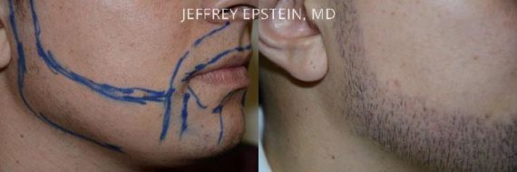 Trasplante de Pelo Facial Before and after in Miami, FL, Paciente 73779