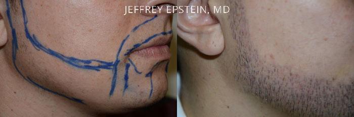 Facial Hair Transplant Before and after in Miami, FL, Paciente 36725