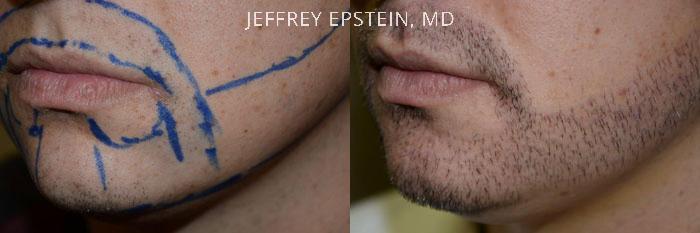 Facial Hair Transplant Before and after in Miami, FL, Paciente 36725
