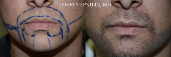 Trasplante de Pelo Facial Before and after in Miami, FL, Paciente 73779