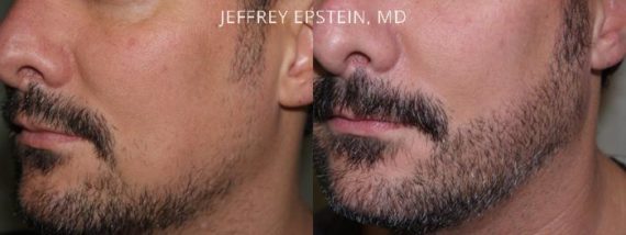 Trasplante de Pelo Facial Before and after in Miami, FL, Paciente 73746