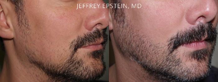 Facial Hair Transplant Before and after in Miami, FL, Paciente 36732