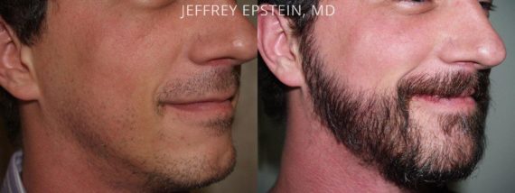 Trasplante de Pelo Facial Before and after in Miami, FL, Paciente 73517