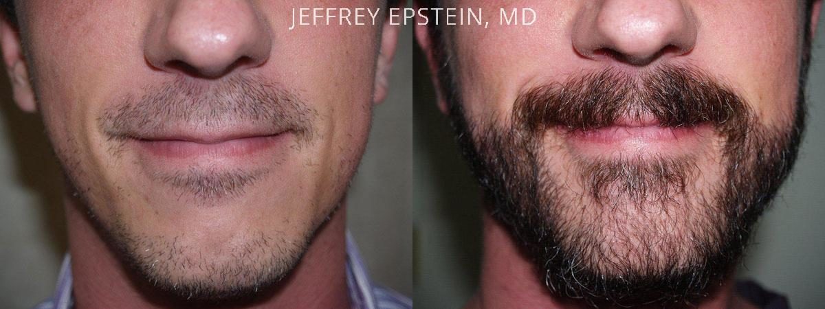 Trasplante de Pelo Facial Antes y después en Miami, FL, Paciente 73517