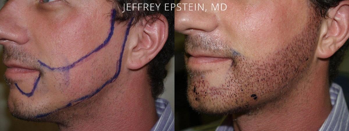 Trasplante de Pelo Facial Antes y después en Miami, FL, Paciente 73517