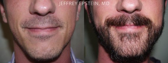 Facial Hair Transplant Before and after in Miami, FL, Paciente 36737