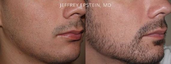 Facial Hair Before and after in Miami, FL, Paciente 36751