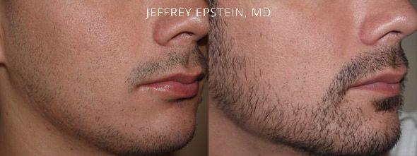 Facial Hair Transplant Before and after in Miami, FL, Paciente 36751